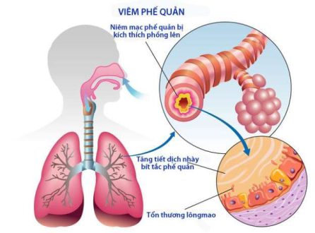 Hình ảnh mô tả viêm phế quản