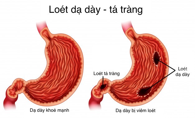 Loét dạ dày là tổn thương viêm loét ở niêm mạc dạ dày