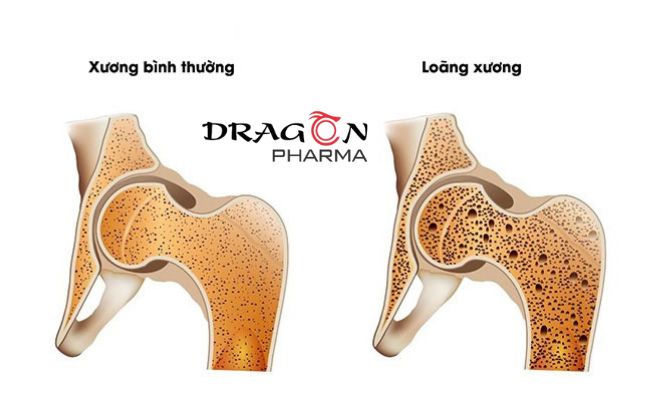 Giảm mật độ khoáng xương dẫn đến bệnh loãng xương