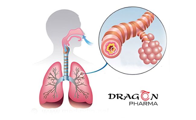 Acute bronchitis and what you need to know to prevent it