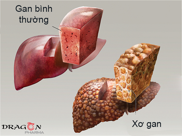 Xơ gan hình thành các mô sẹo không thể phục hồi