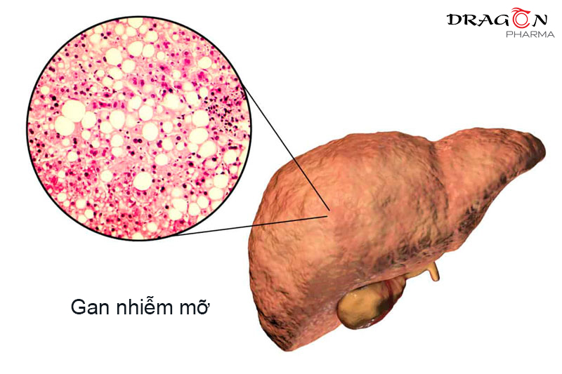 Bệnh gan nhiễm mỡ có thể tiến triển thành xơ gan, viêm gan 