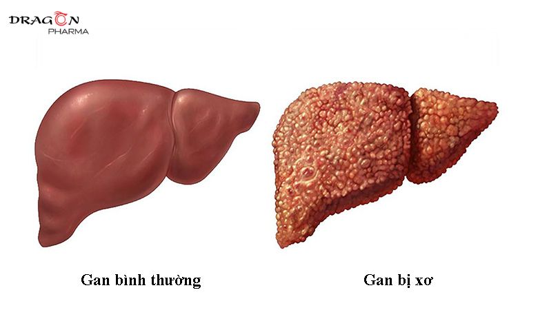 Xơ gan – Nguyên nhân, triệu chứng và cách điều trị hiệu quả