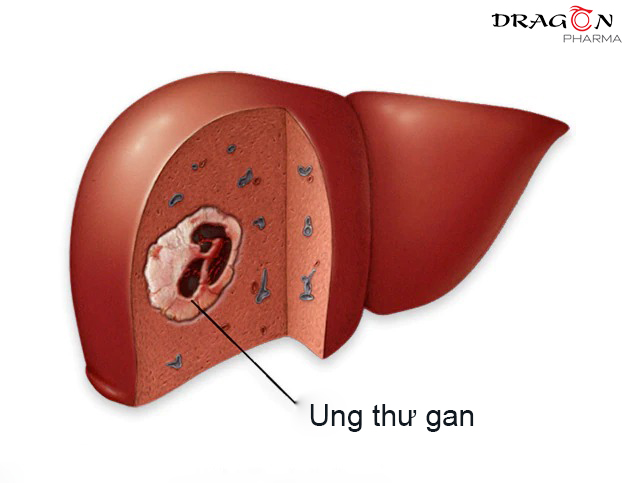 Ung thư gan gây nguy hiểm đến tính mạng người bệnh