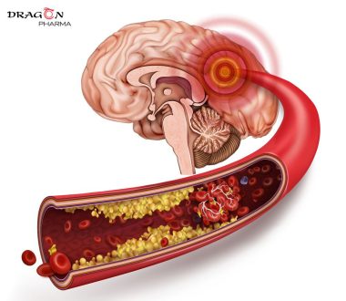 Thiểu năng tuần hoàn não là tình trạng thiếu máu lên não