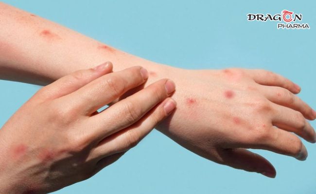 Đậu mùa khỉ (mpox) đang diễn ra tại CHDC Congo có nguy cơ dễ lây lan hơn