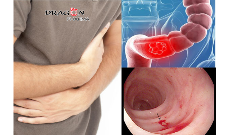 Viêm loét đại tràng là tình trạng viêm và tổn thương lớp niêm mạc bên trong đại tràng