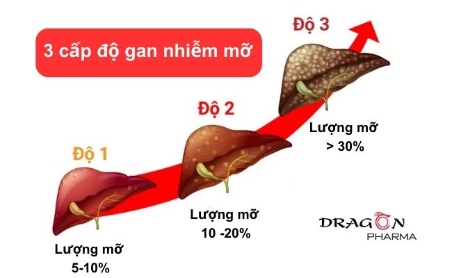 3 cấp độ của gan nhiễm mỡ