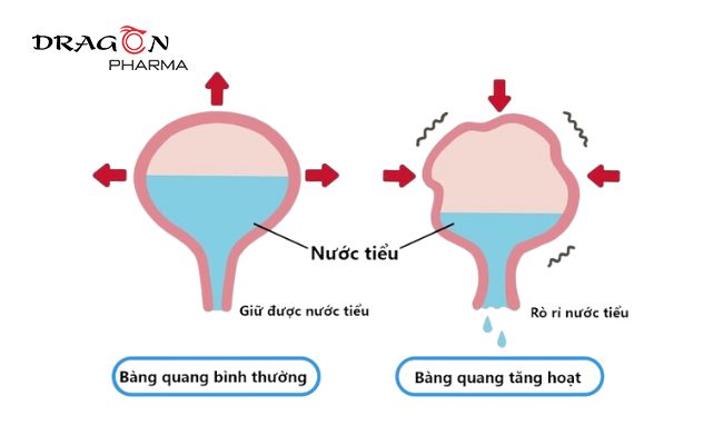 Bàng quang tăng hoạt là tình trạng các cơ bàng quang hoạt động quá mức