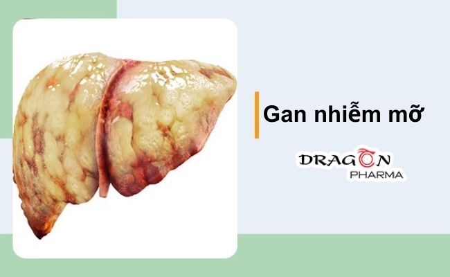 Bệnh gan nhiễm mỡ: Hiểu đúng bệnh, phòng và trị đúng cách