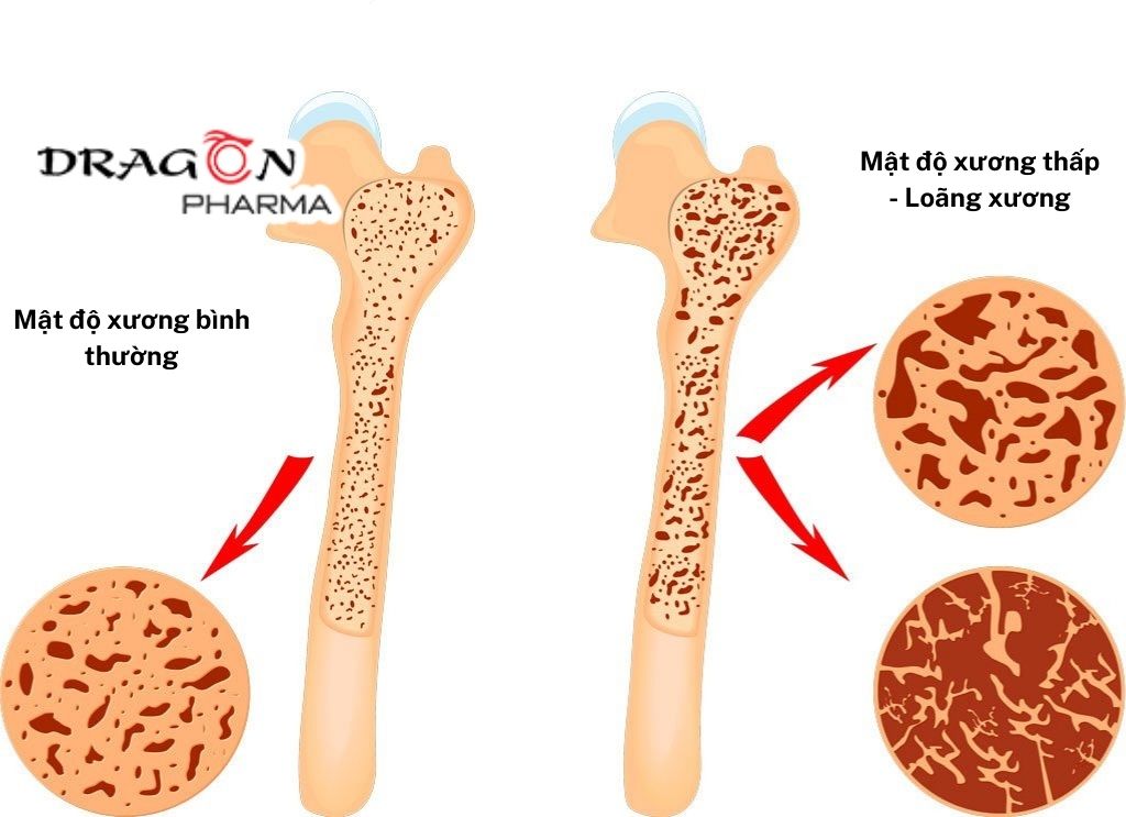 Loãng xương: Nguyên nhân và cách phòng ngừa hiệu quả