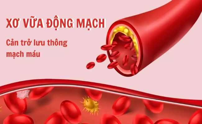 Xơ vữa động mạch là một trong những nguyên nhân gây đột quỵ