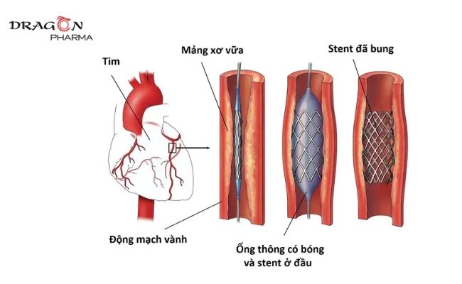 Trường hợp nặng cần phải can thiệp bằng phẫu thuật nong mạch và đặt stent