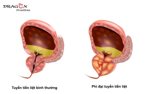 Tuyến tiền liệt bình thường và phì đại tuyến tiền liệt 