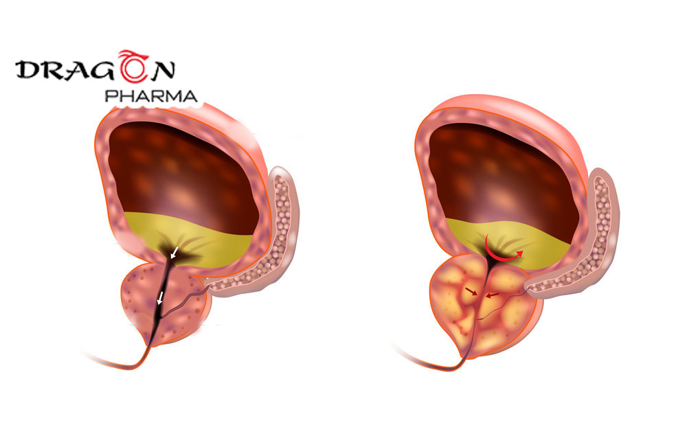 Phì đại tuyến tiền liệt: Nguyên nhân, triệu chứng và cách điều trị hiệu quả