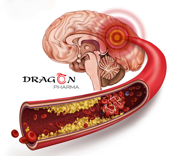 Thiểu năng tuần hoàn não: Sát thủ tiềm ẩn nguy cơ gây đột quỵ