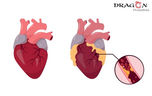 Thừa cân béo phì có nguy cơ dẫn đến các bệnh tim mạch