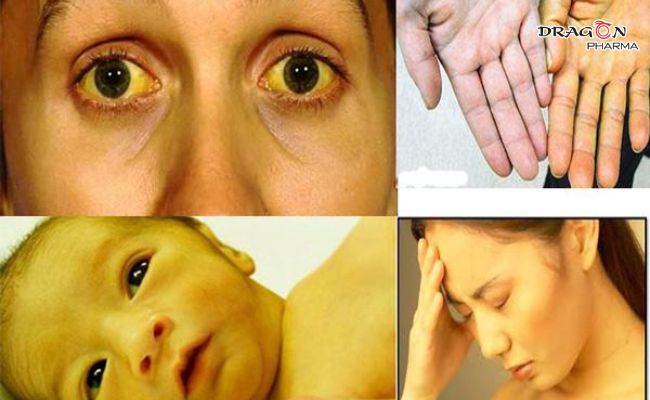 Vàng mắt, vàng da là những triệu chứng viêm gan thường gặp