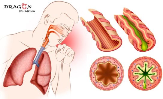 Viêm phế quản cấp tính gây co thắt và tăng tiết dịch đờm