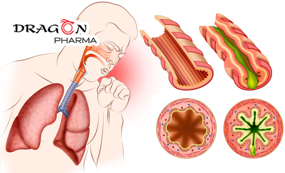 Tất tần tật về viêm phế quản cấp tính mà bạn cần biết